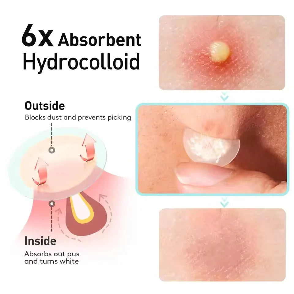 Luvenest Invisible Hydrocolloid Pimple Patches